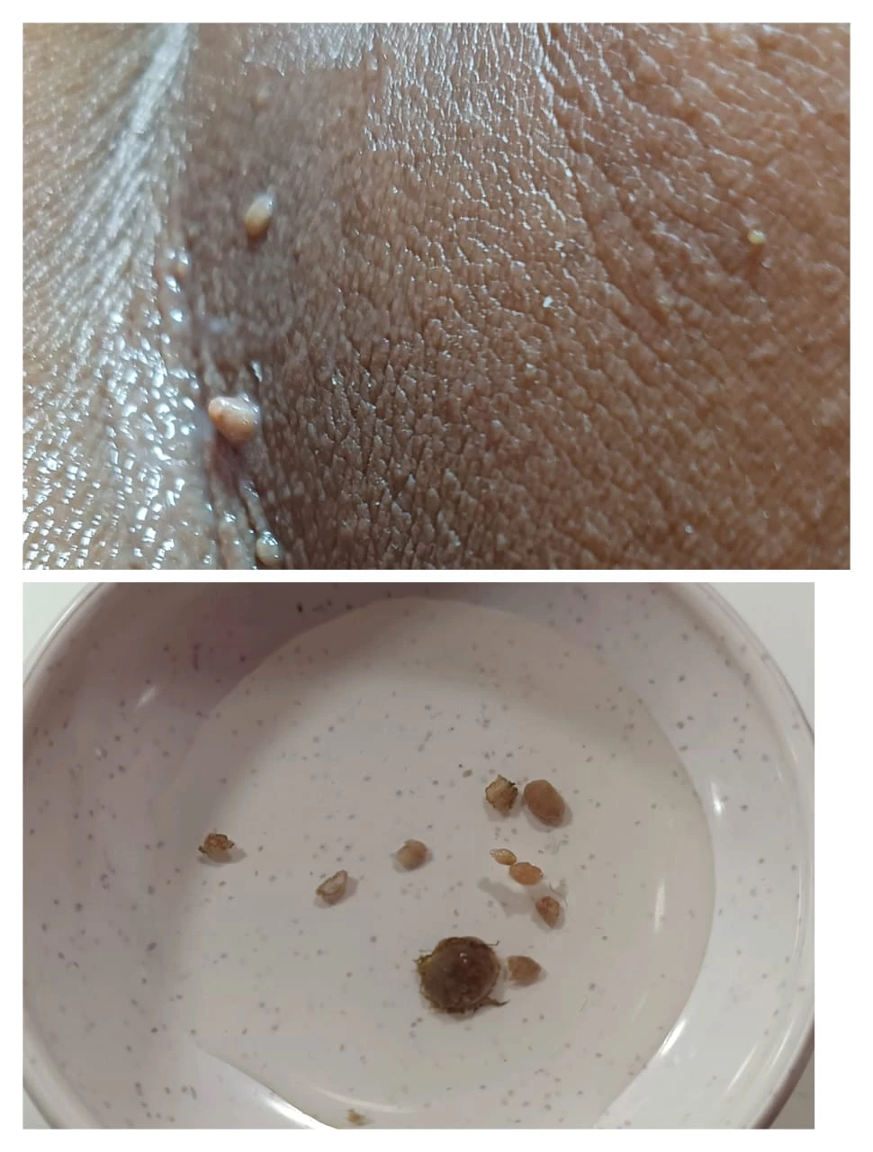 VOUCHER 50% CLASS SKINTAGS REMOVAL