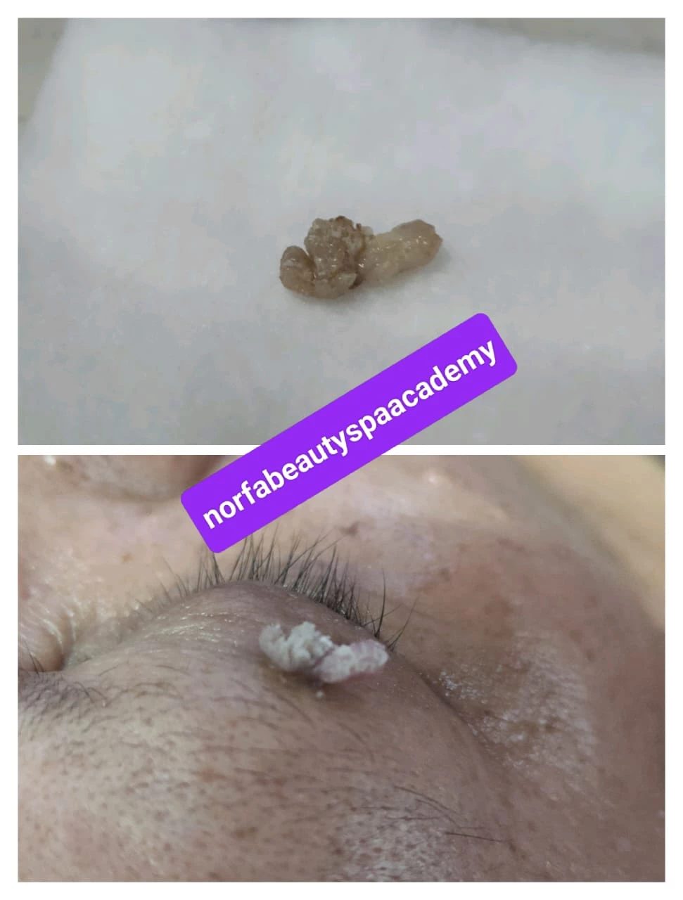 FACIAL SKINTAGS PROMOTION