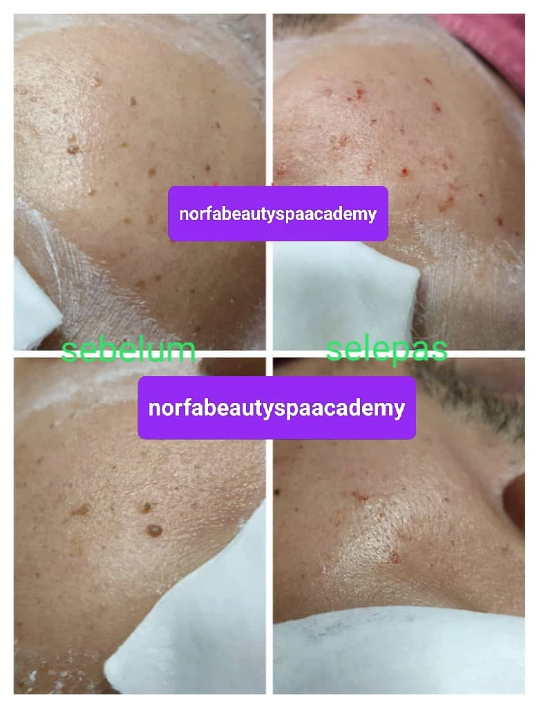 Skin Tags Facial Treatment